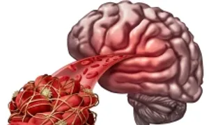 7 dấu hiệu cảnh báo cục máu đông dễ bị bỏ qua